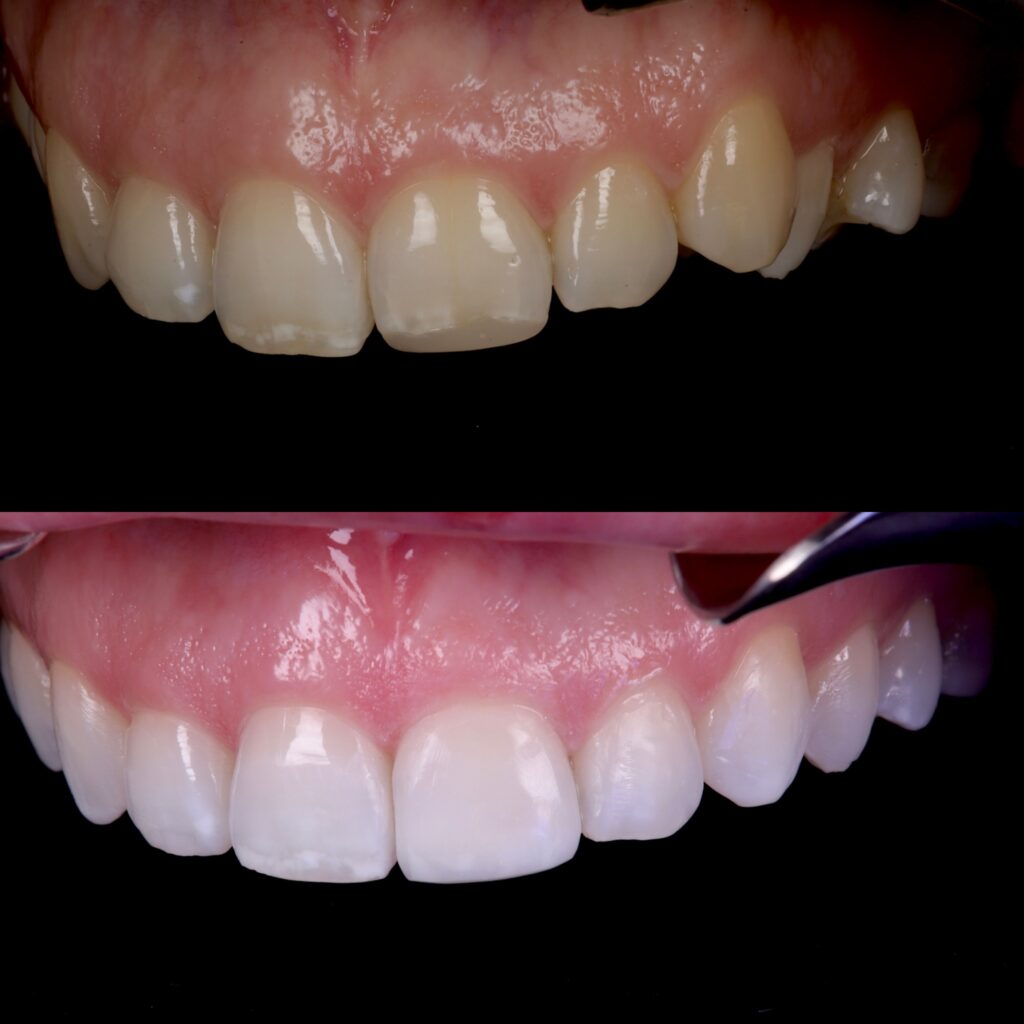 Close-up alignment correction with Invisalign, before and after