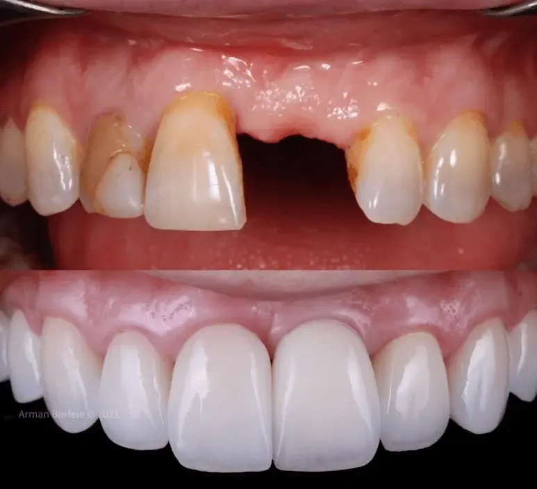 Before and after smile transformation at London Dental Arts, Forest Hill — case 9