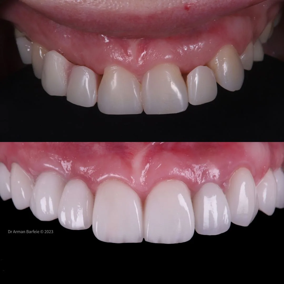 Before and after smile transformation at London Dental Arts, Forest Hill — case 45