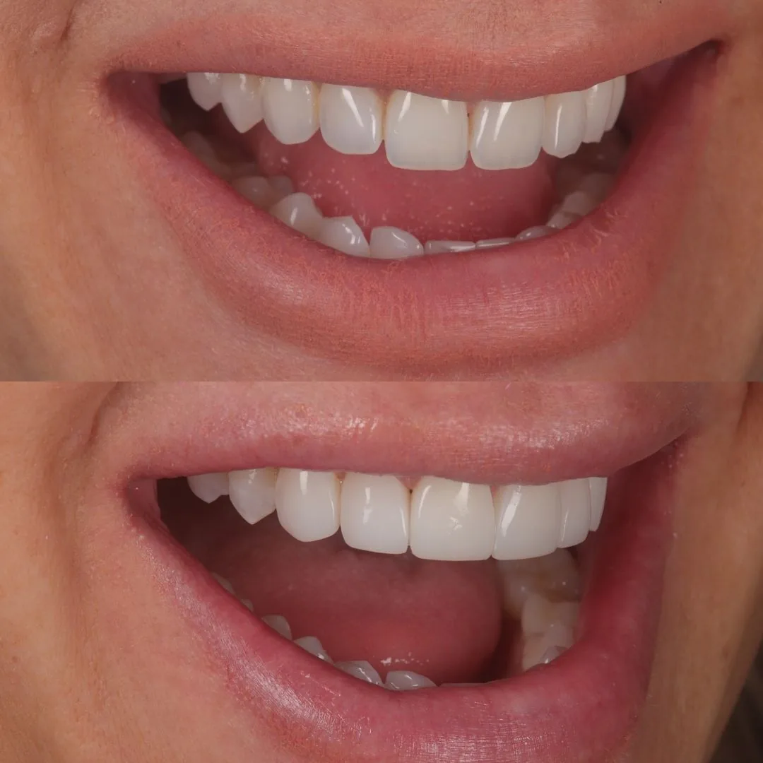 Before and after smile transformation at London Dental Arts, Forest Hill — case 39