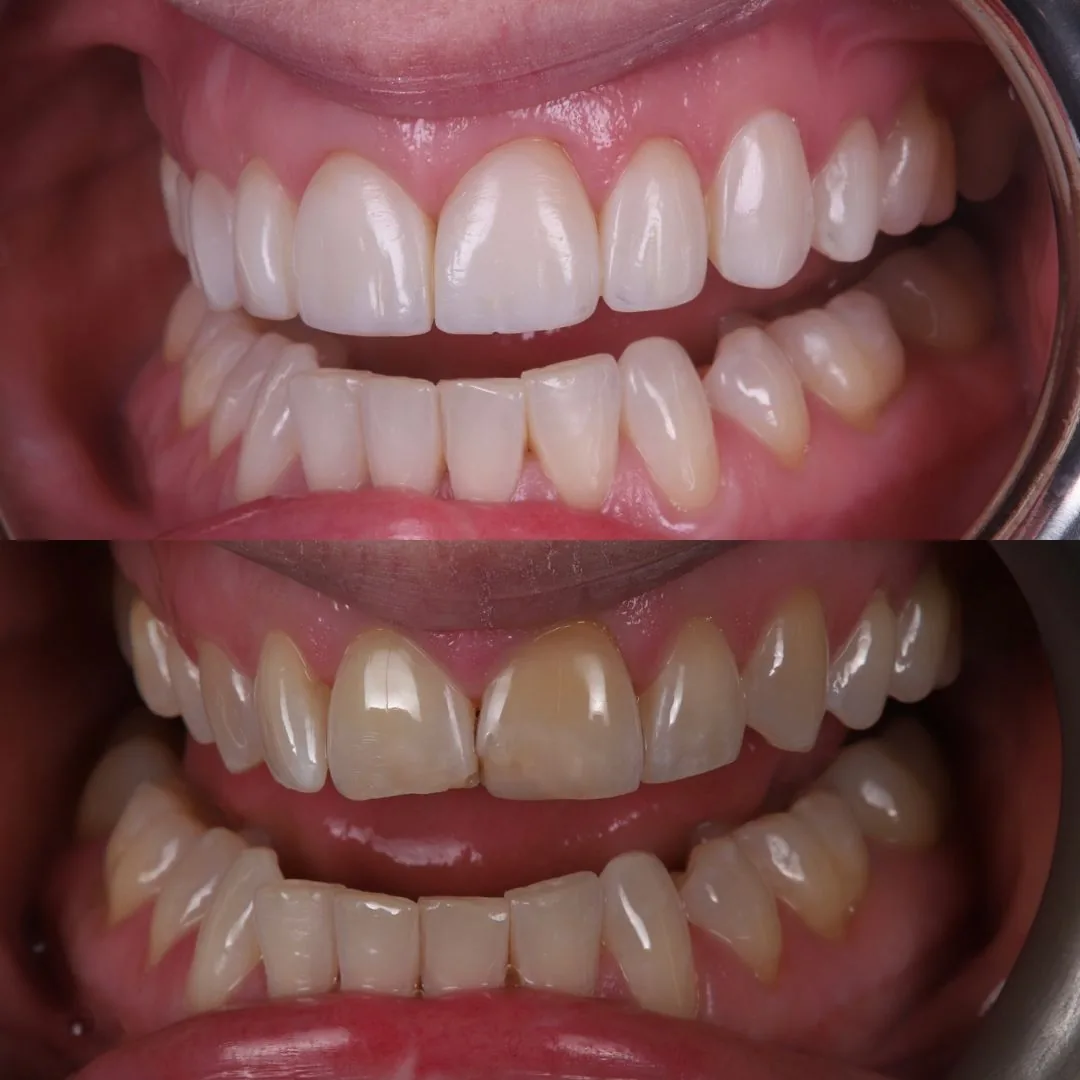 Before and after smile transformation at London Dental Arts, Forest Hill — case 32