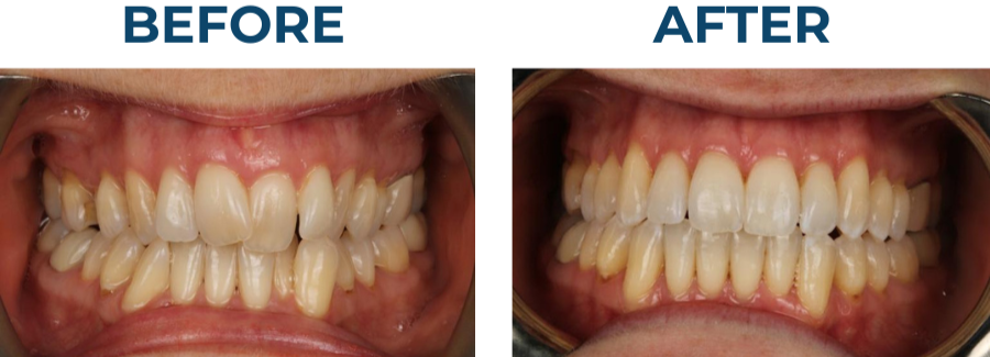 Before and after Invisalign treatment showing straighter teeth