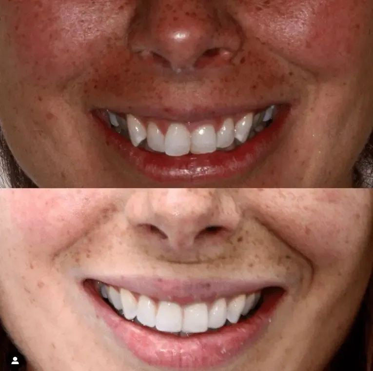 Before and after smile transformation at London Dental Arts, Forest Hill — case 7