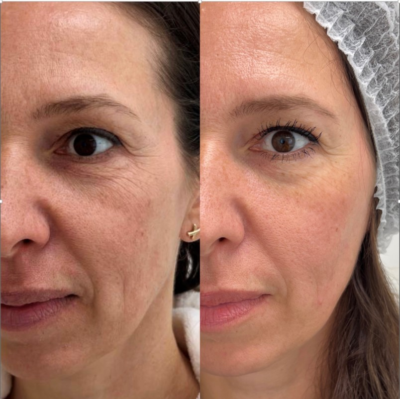 Jalupro facial skin before and after result