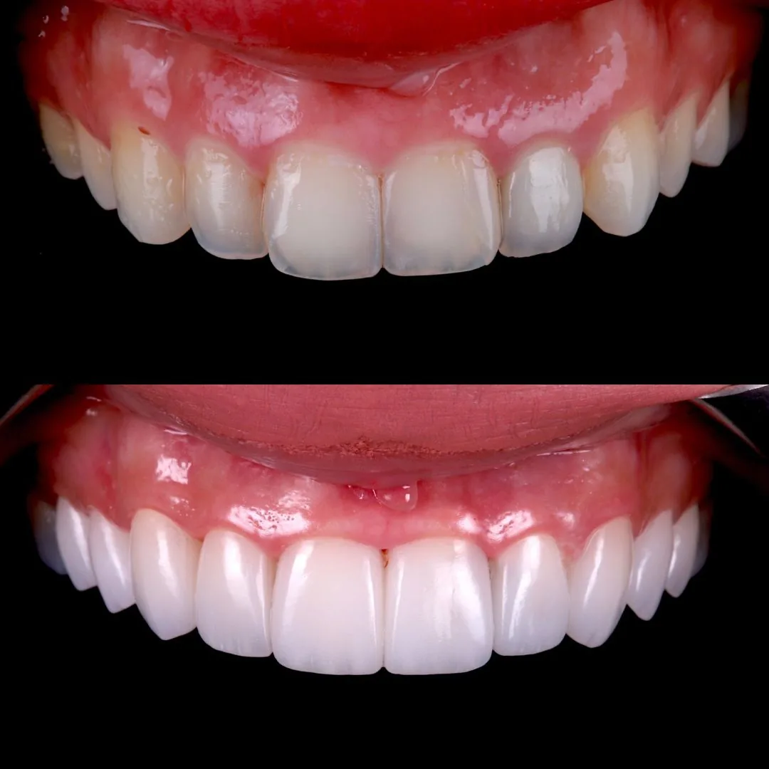 Before and after smile transformation at London Dental Arts, Forest Hill — case 33
