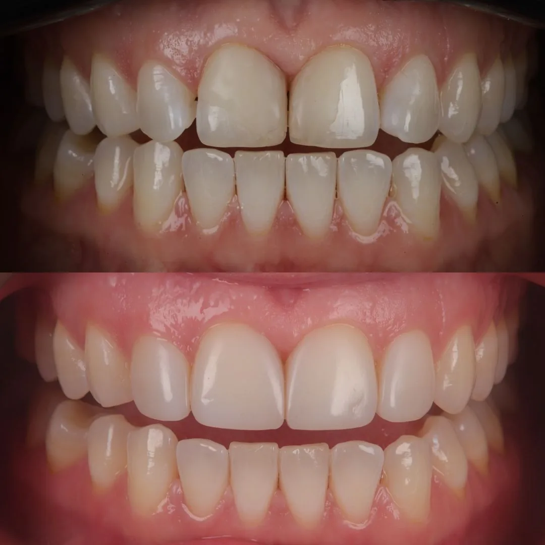 Before and after smile transformation at London Dental Arts, Forest Hill — case 20