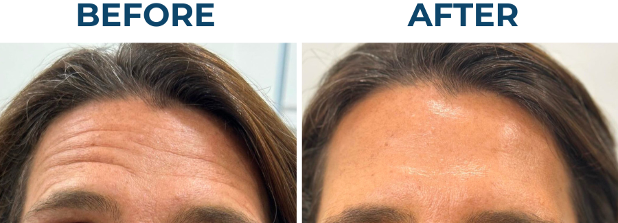 Before and after facial aesthetics treatment softening forehead lines