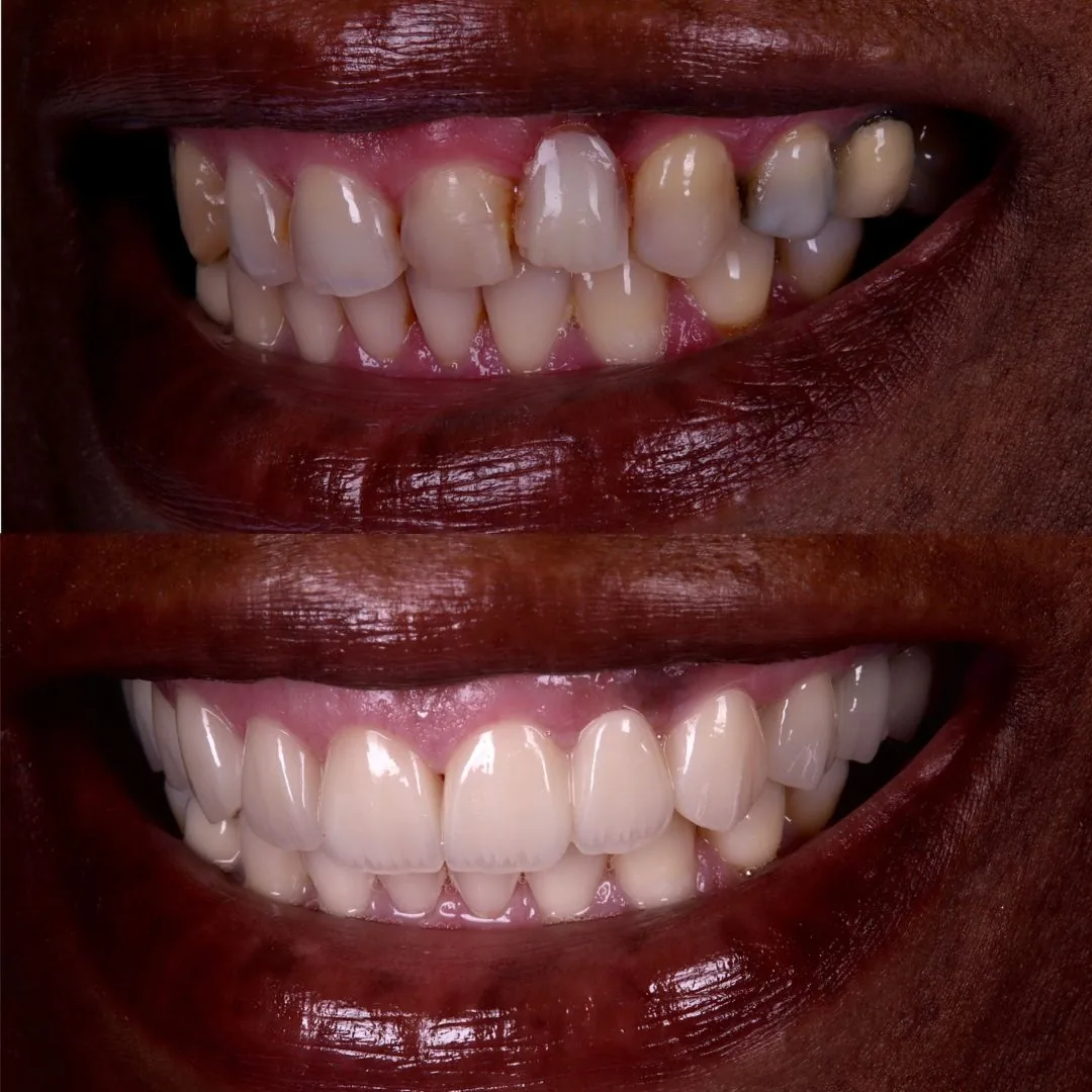Before and after smile transformation at London Dental Arts, Forest Hill — case 49