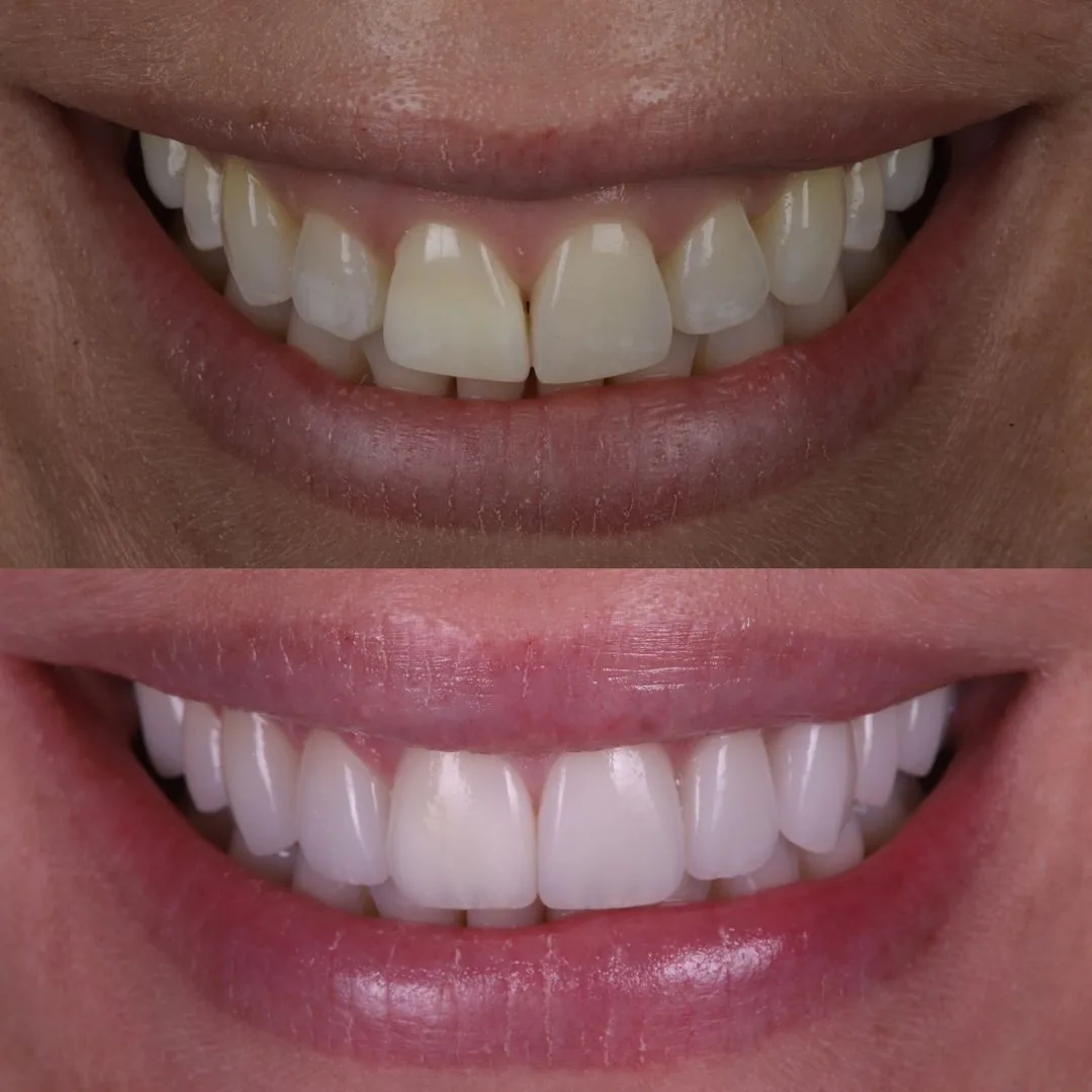 Before and after smile transformation at London Dental Arts, Forest Hill — case 14