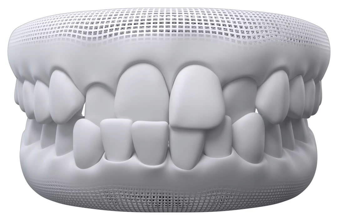 Crossbite alignment concern