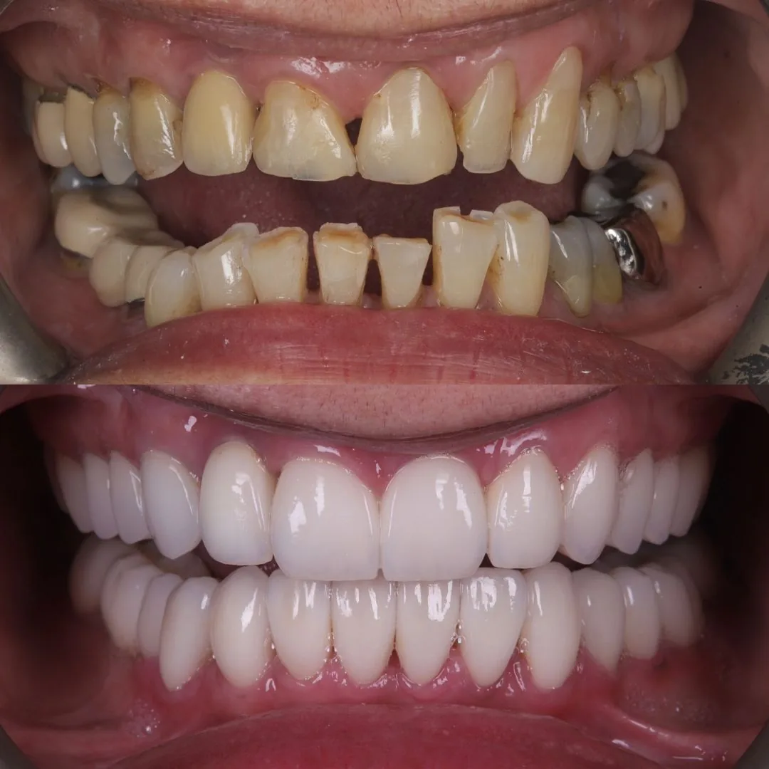 Before and after smile transformation at London Dental Arts, Forest Hill — case 48