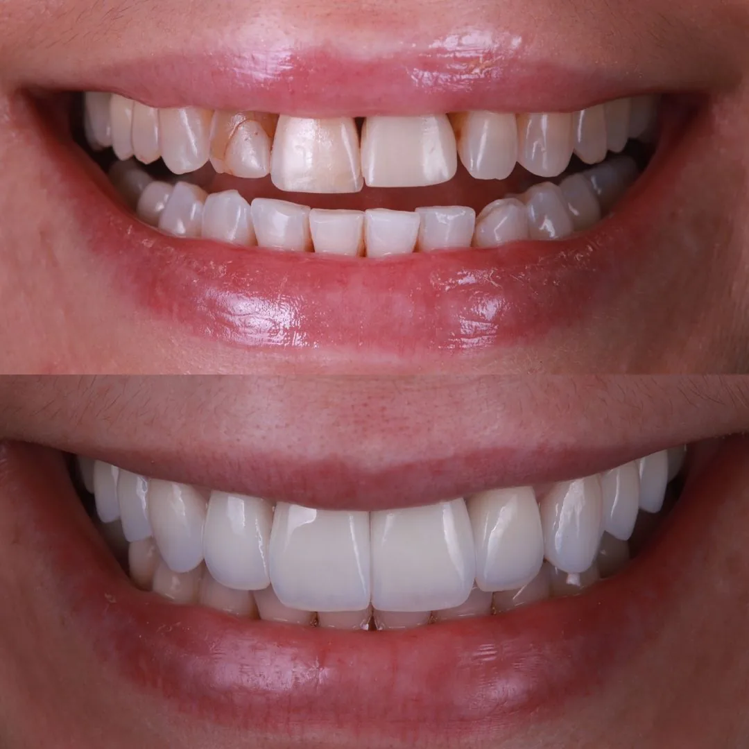 Before and after smile transformation at London Dental Arts, Forest Hill — case 18