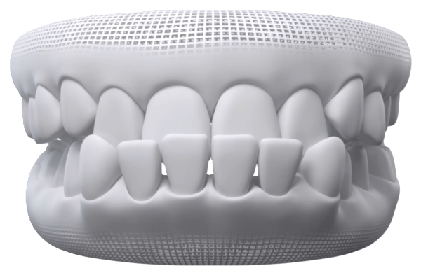 Underbite alignment concern
