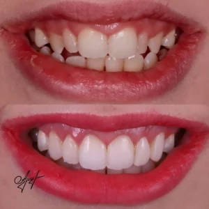 Before and after Invisalign treatment straightening crowded teeth