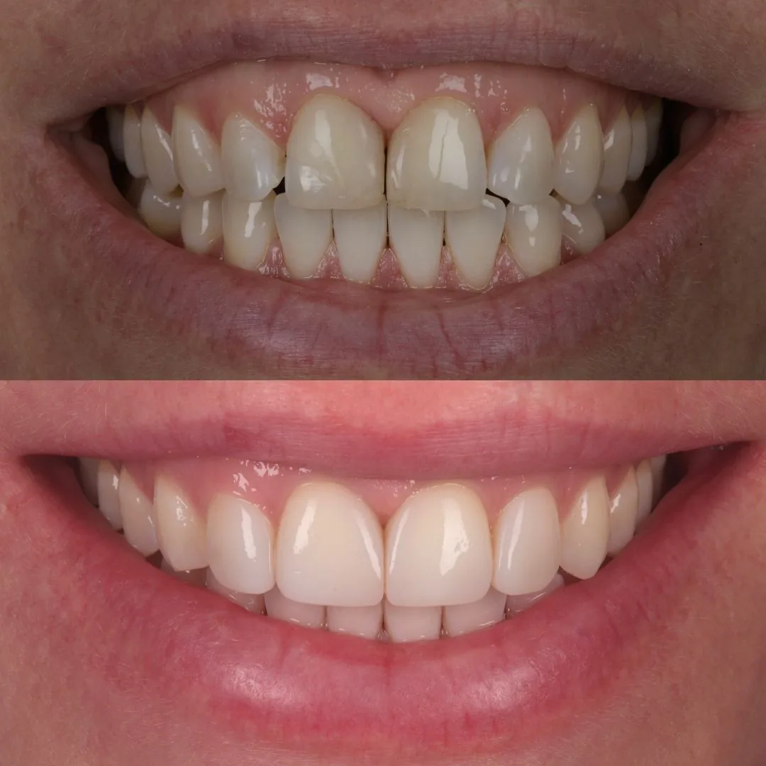 Before and after smile transformation at London Dental Arts, Forest Hill — case 15