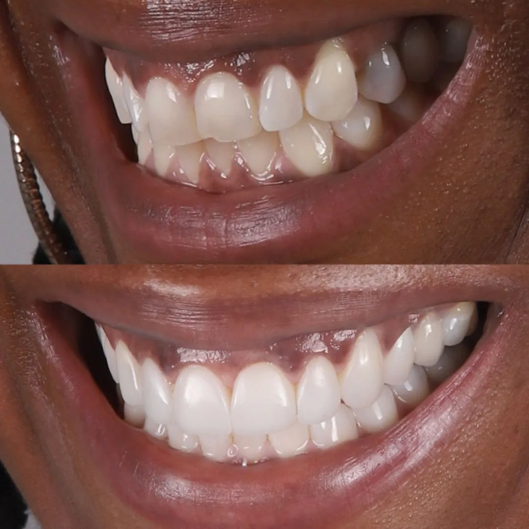 Before and after smile transformation at London Dental Arts, Forest Hill — case 44