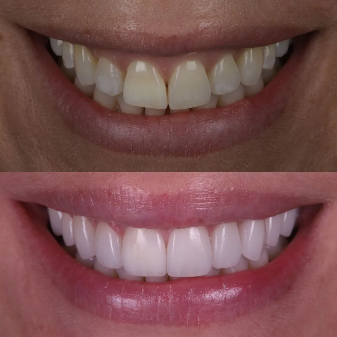Before and after smile transformation at London Dental Arts, Forest Hill — case 42