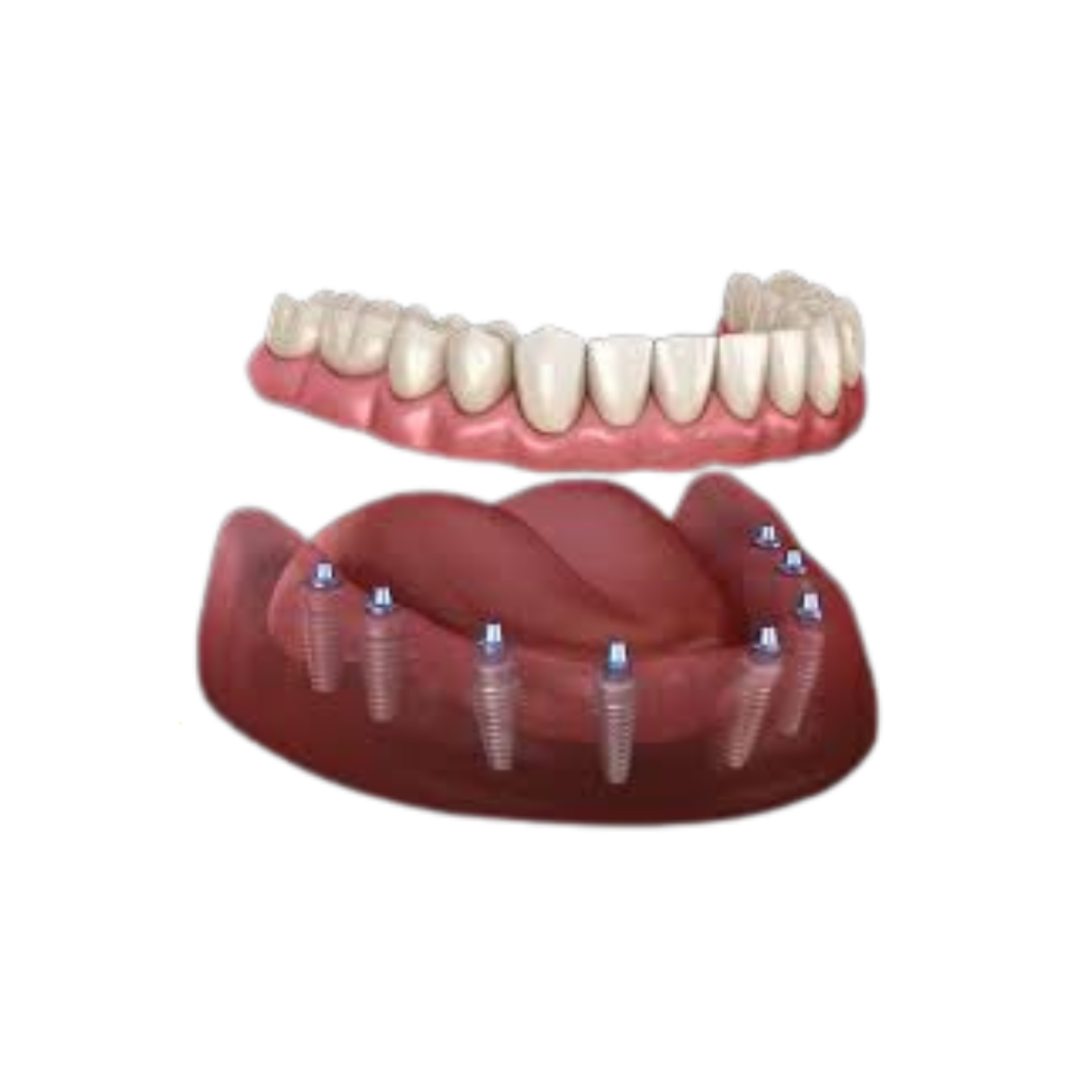 All-on-4 dental implant model with a full arch of replacement teeth