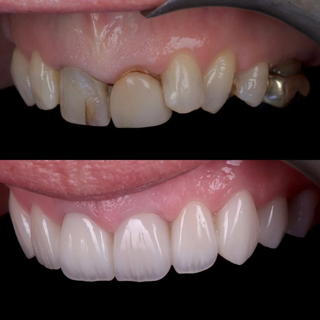 Before and after smile transformation at London Dental Arts, Forest Hill — case 28