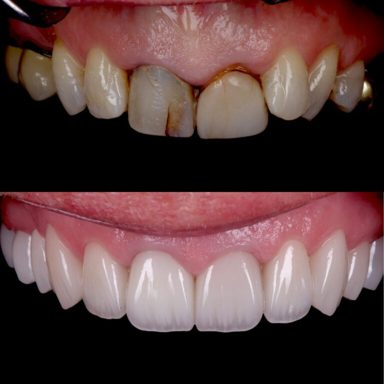 Front tooth implant before and after