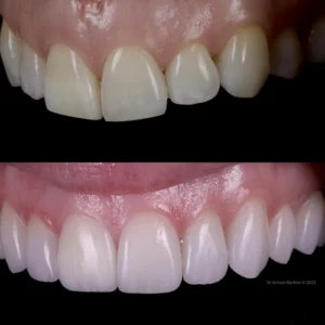 Before and after porcelain veneers creating an even, brighter smile