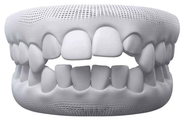 Open Bite alignment concern