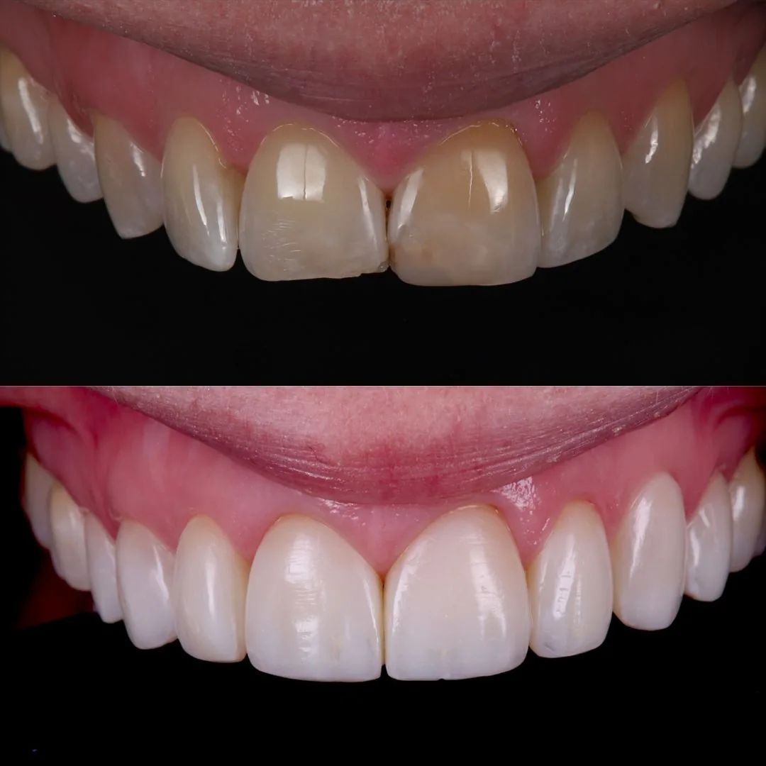 Before and after smile transformation at London Dental Arts, Forest Hill — case 13