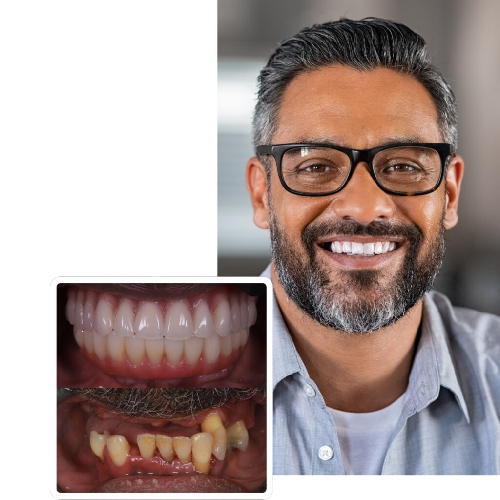 Full mouth implant restoration before and after