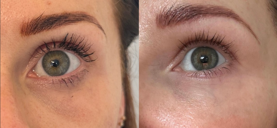 Jalupro eye area before and after result