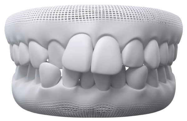 Crowded Teeth alignment concern