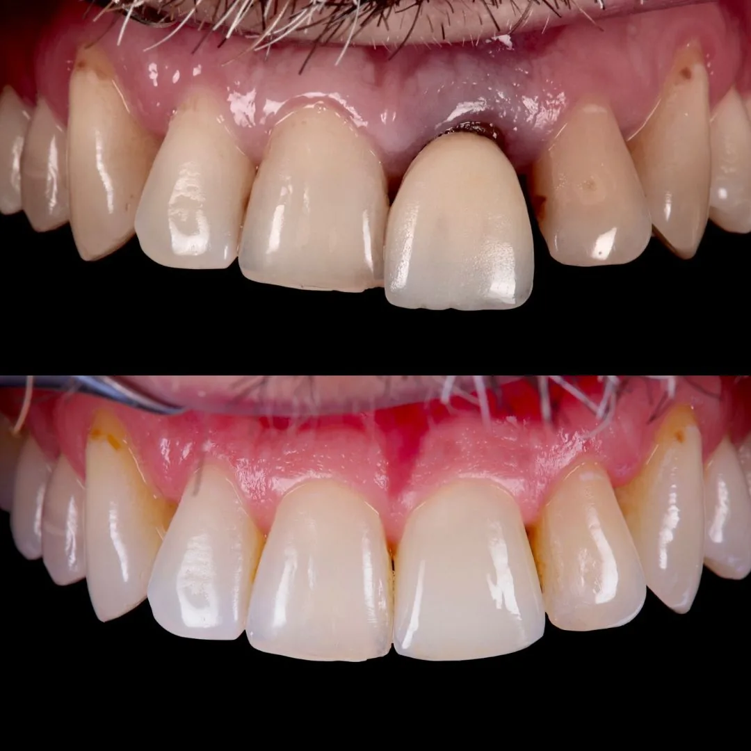 Before and after smile transformation at London Dental Arts, Forest Hill — case 29