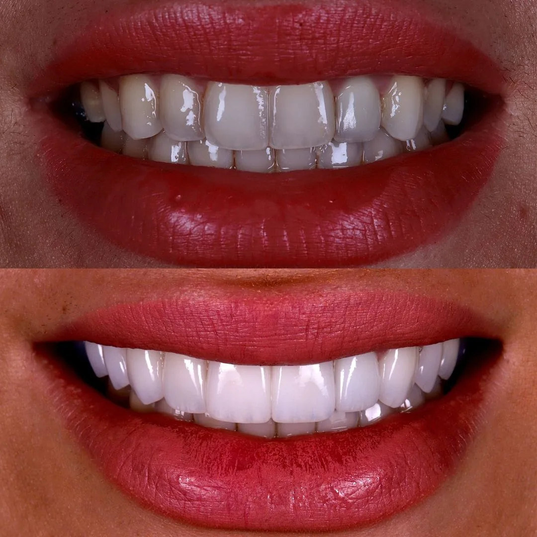 Before and after smile transformation at London Dental Arts, Forest Hill — case 23