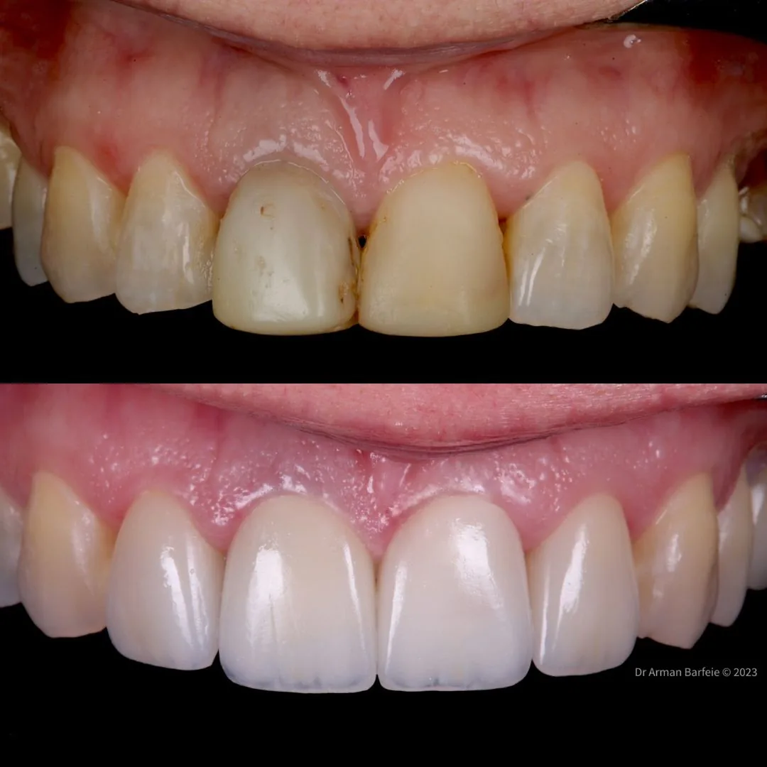 Before and after smile transformation at London Dental Arts, Forest Hill — case 10
