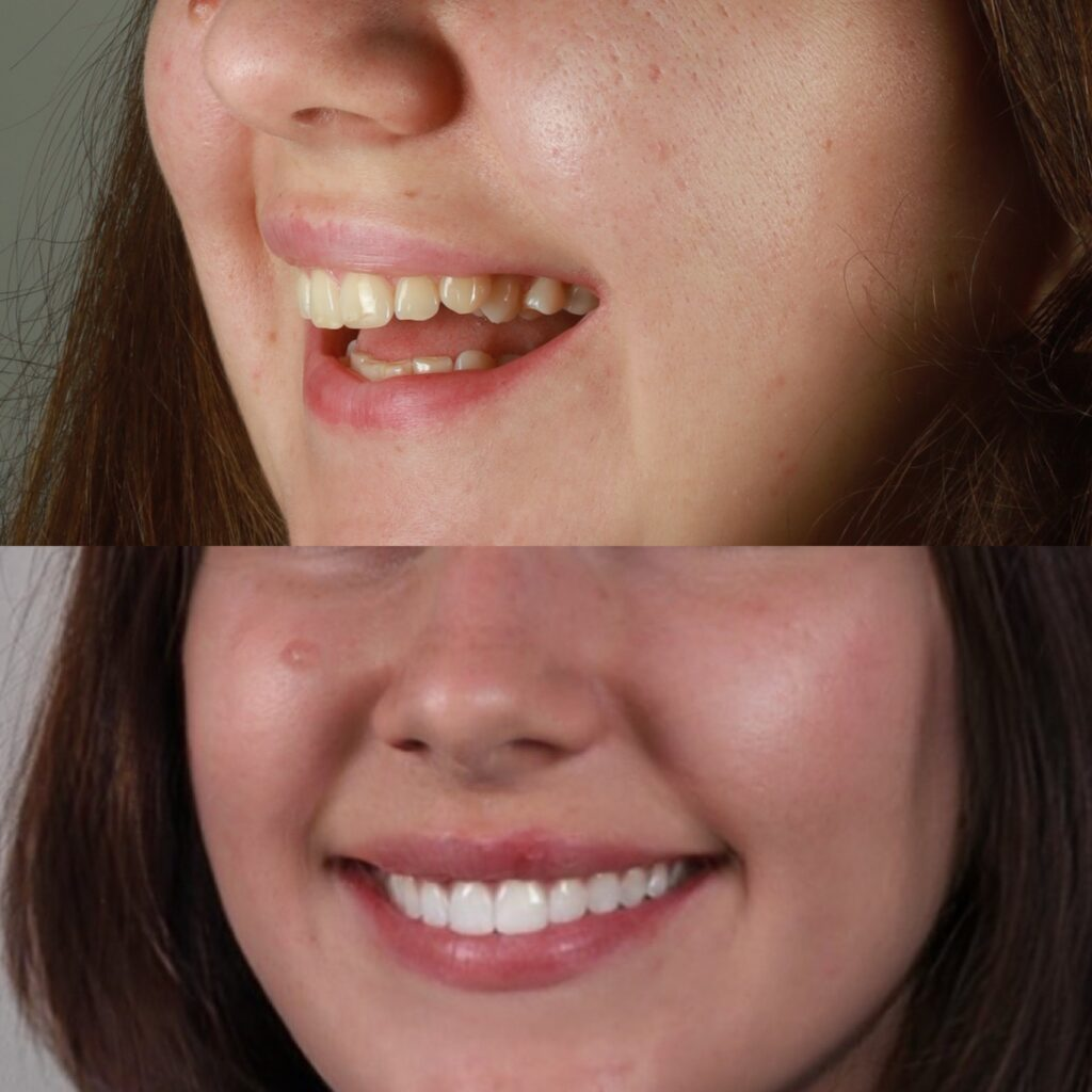 Crowded teeth straightened with Invisalign, before and after