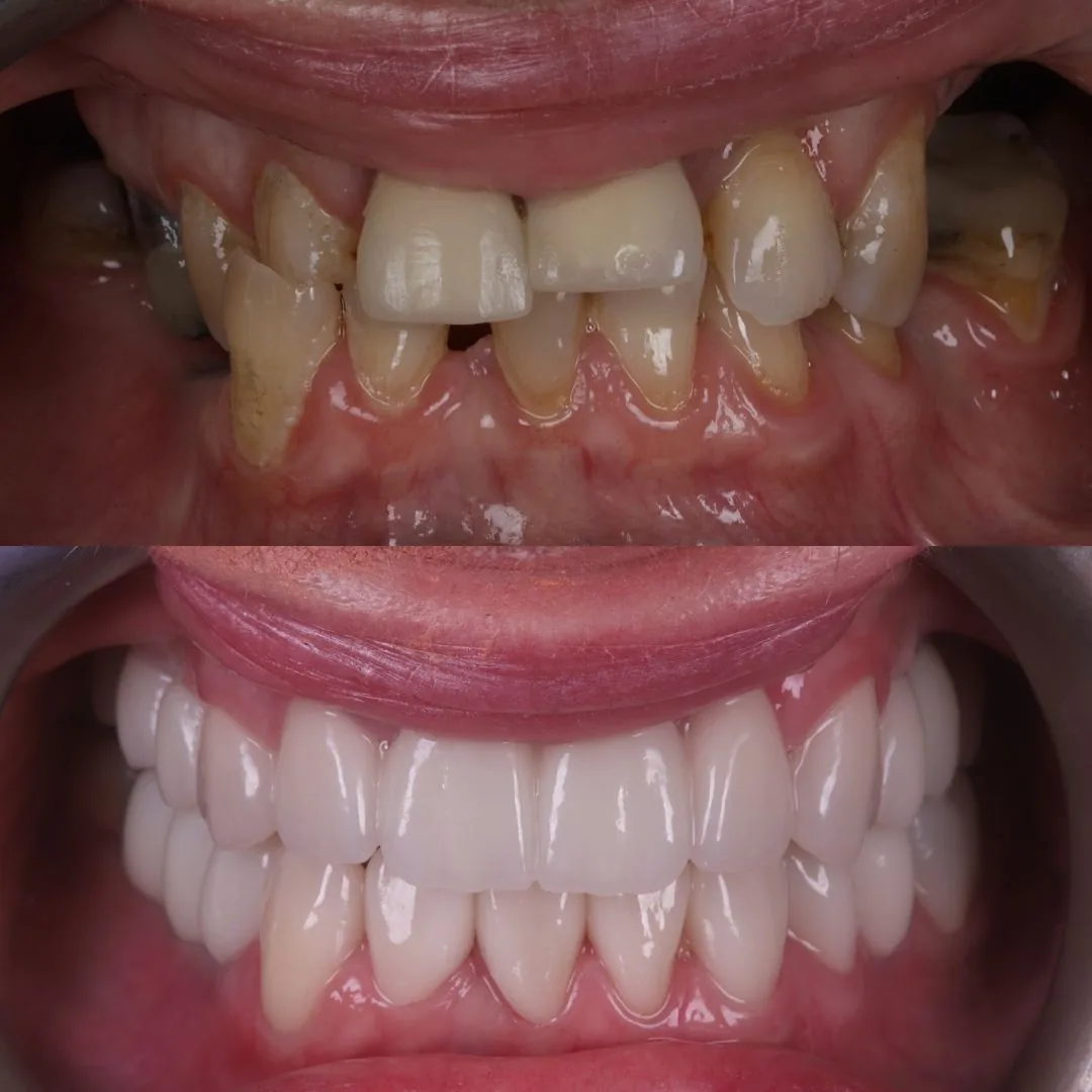 Before and after smile transformation at London Dental Arts, Forest Hill — case 22