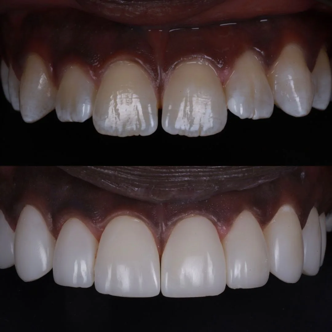 Before and after smile transformation at London Dental Arts, Forest Hill — case 24