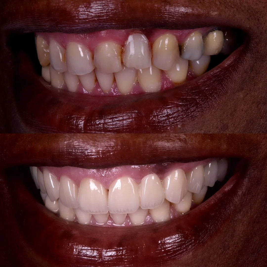 Before and after smile transformation at London Dental Arts, Forest Hill — case 21