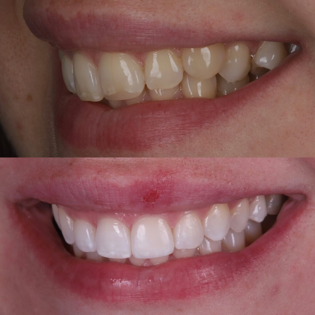 Bite correction with Invisalign, before and after