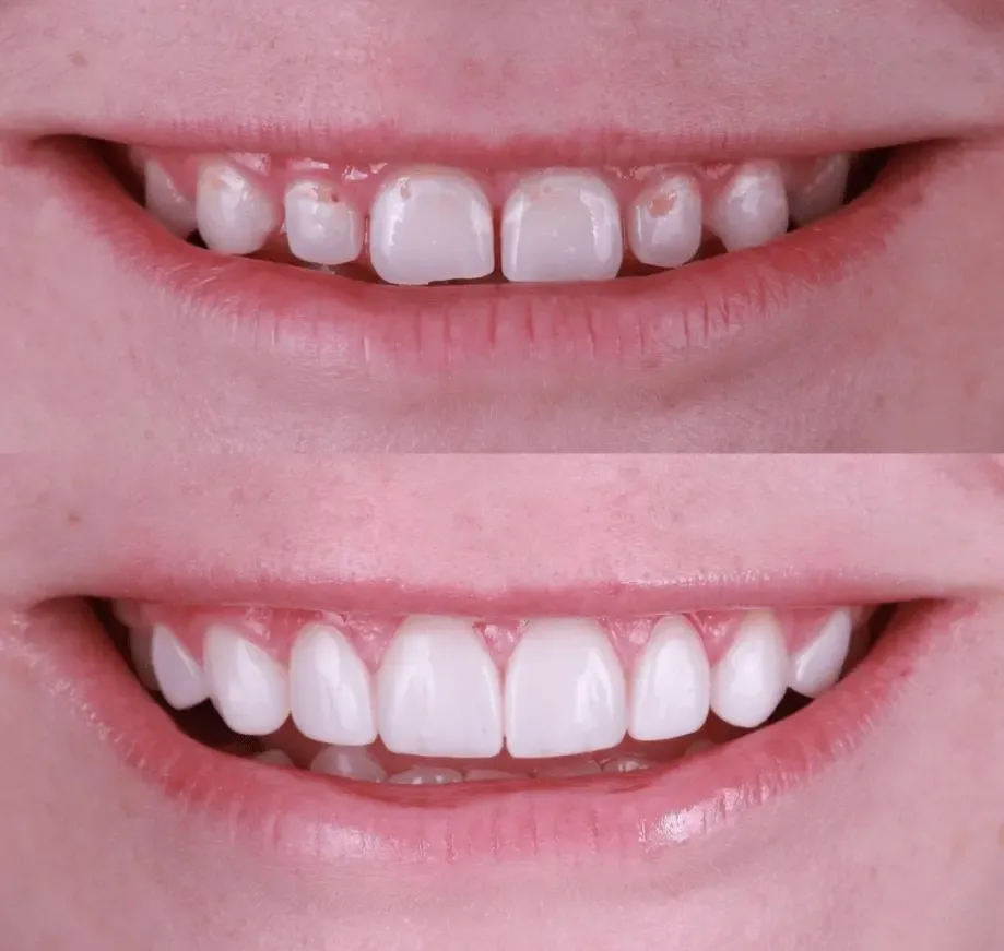 Before and after smile transformation at London Dental Arts, Forest Hill — case 8
