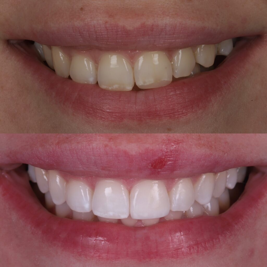 Front tooth gap closed with Invisalign, before and after