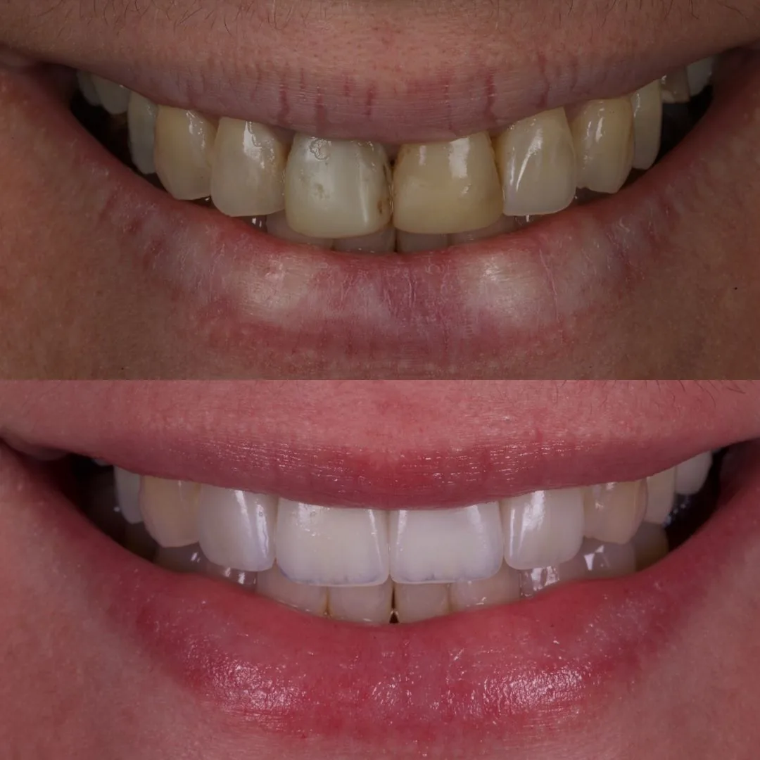 Before and after smile transformation at London Dental Arts, Forest Hill — case 43