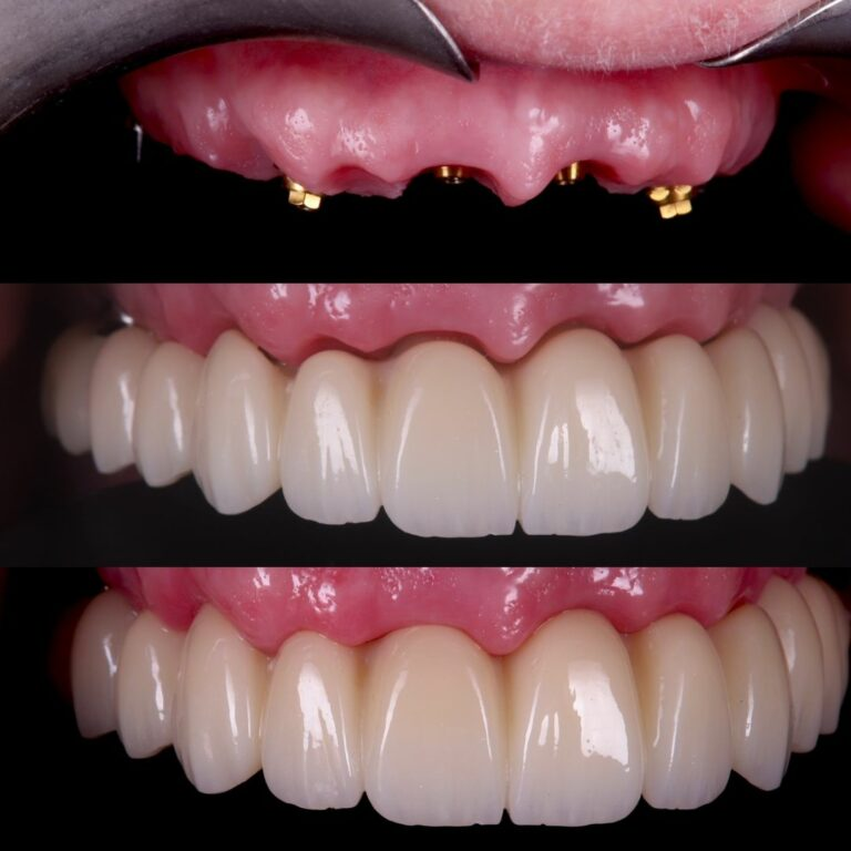 Full arch implant restoration before and after