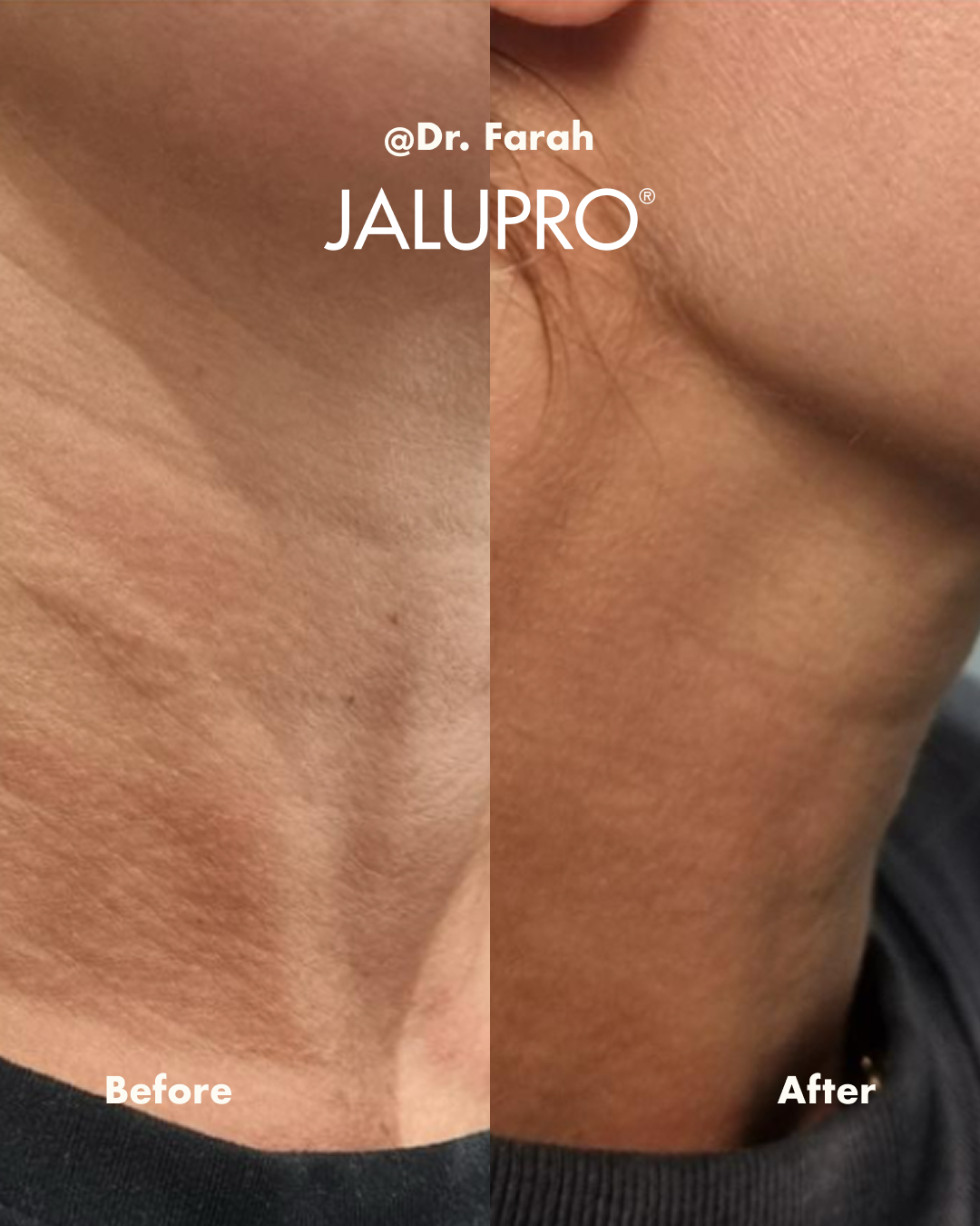Jalupro neck skin before and after result