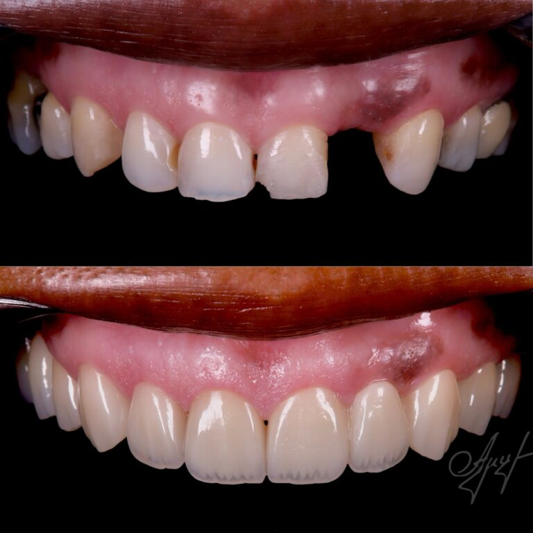 Single tooth implant before and after