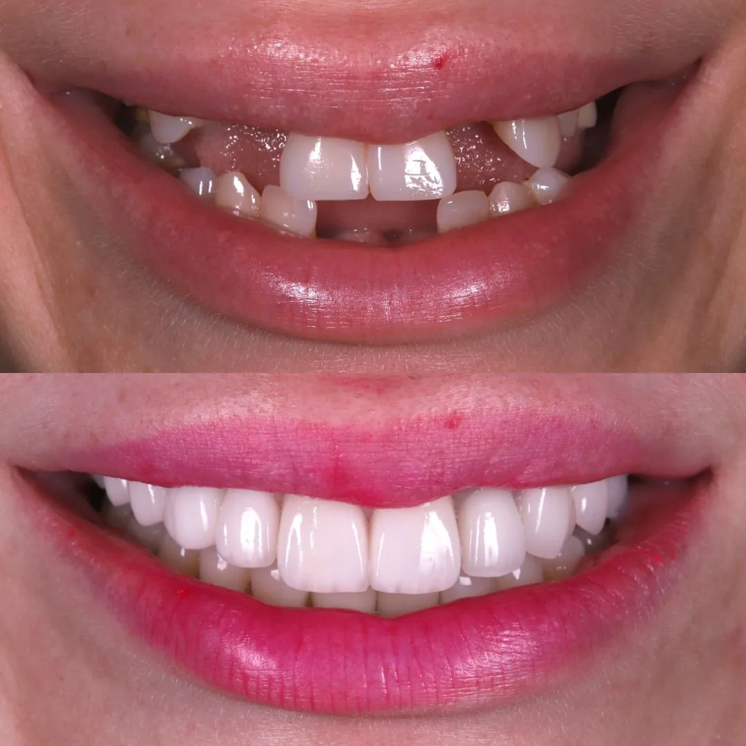Before and after smile transformation at London Dental Arts, Forest Hill — case 16