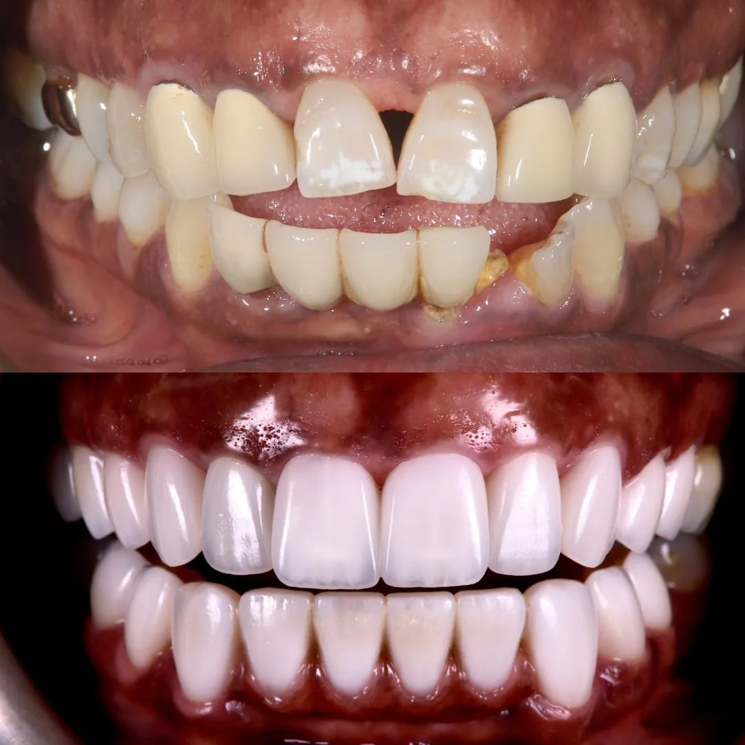 Before and after smile transformation at London Dental Arts, Forest Hill — case 17