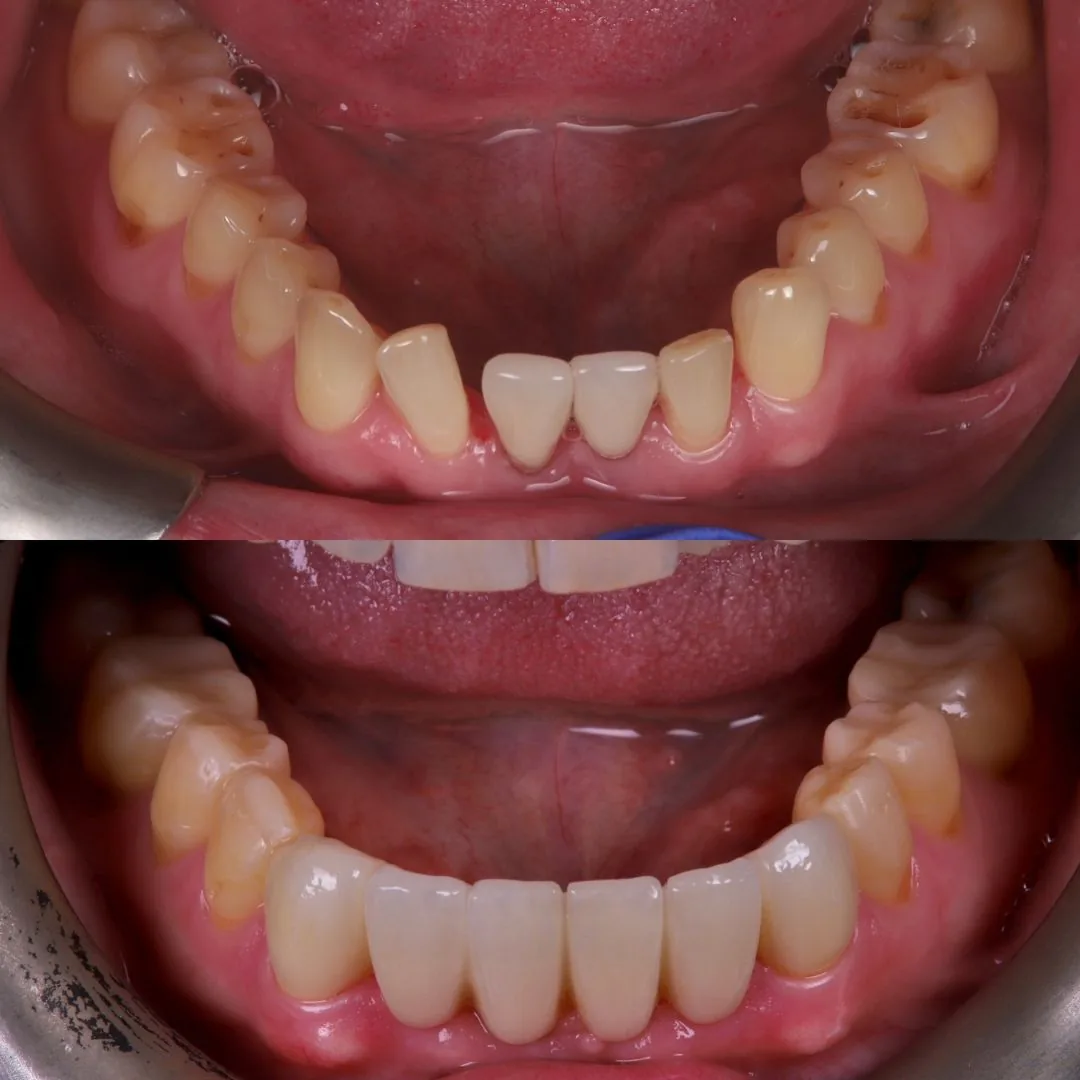 Before and after smile transformation at London Dental Arts, Forest Hill — case 37