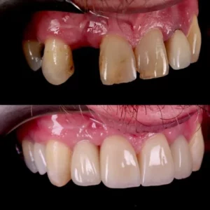 Before and after dental implant treatment replacing a missing upper tooth