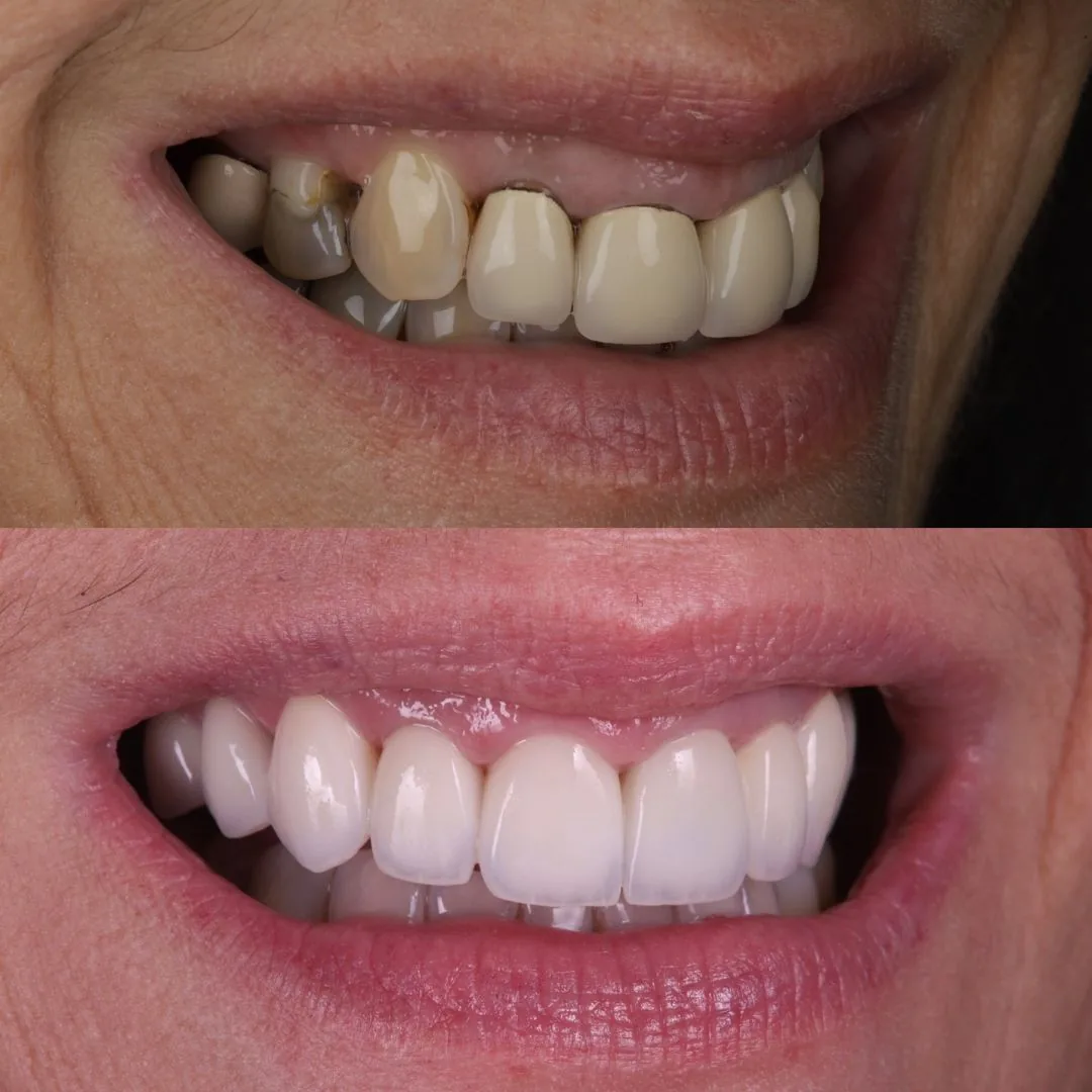Before and after smile transformation at London Dental Arts, Forest Hill — case 38