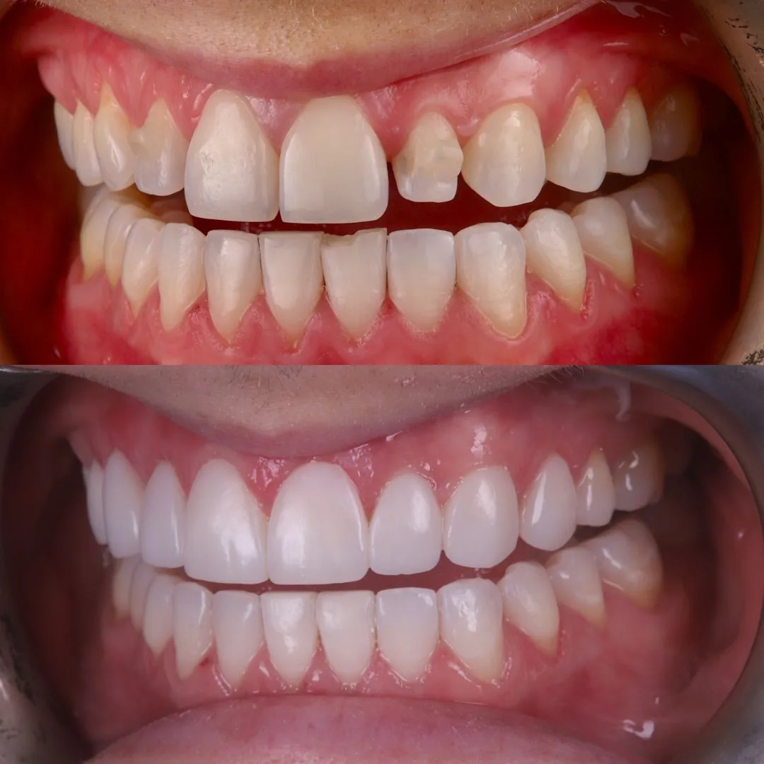 Before and after smile transformation at London Dental Arts, Forest Hill — case 47